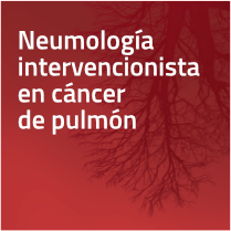 Seminario web Neumología intervencionista en cáncer de pulmón